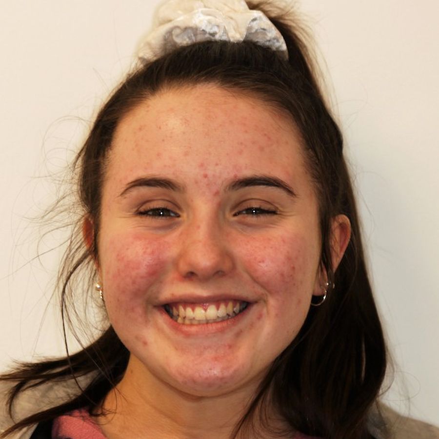 Teenage Braces - Costs and Other Questions - Kids Braces - Emma - after - 3Dental
